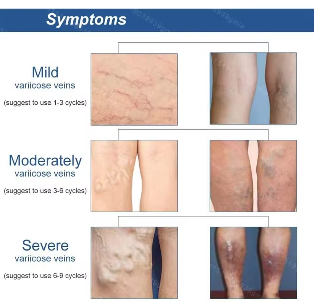 30 pzas parches adhesivos para várices